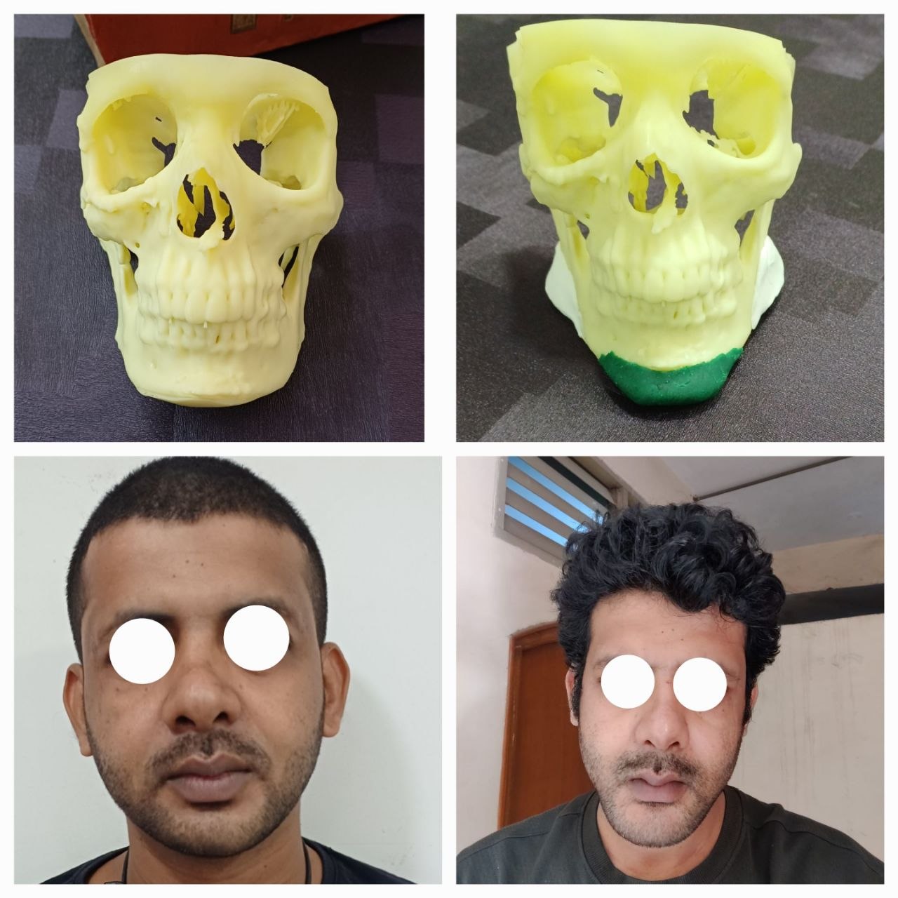 3D Surgical Planning