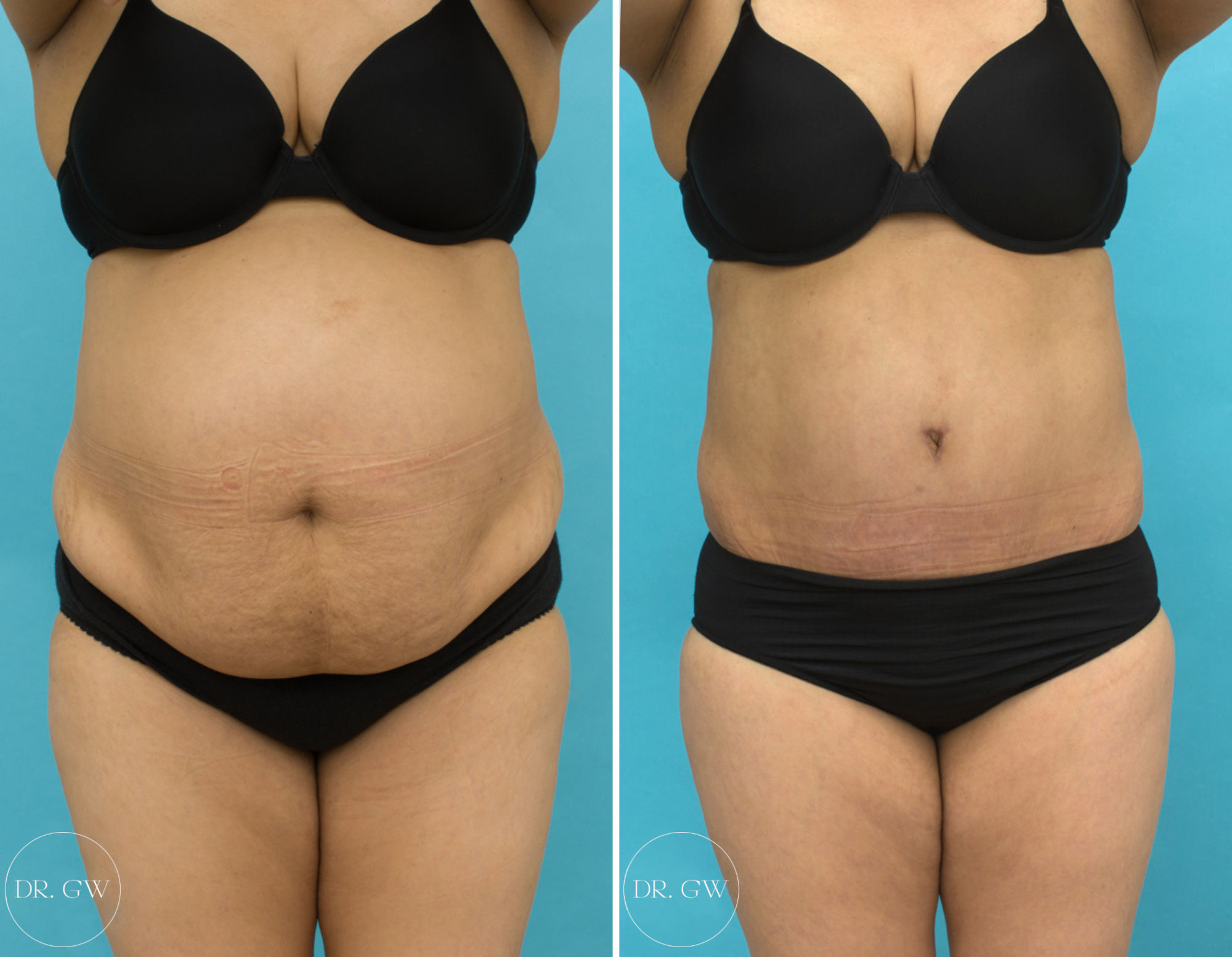 Abdominoplasty with Liposuction