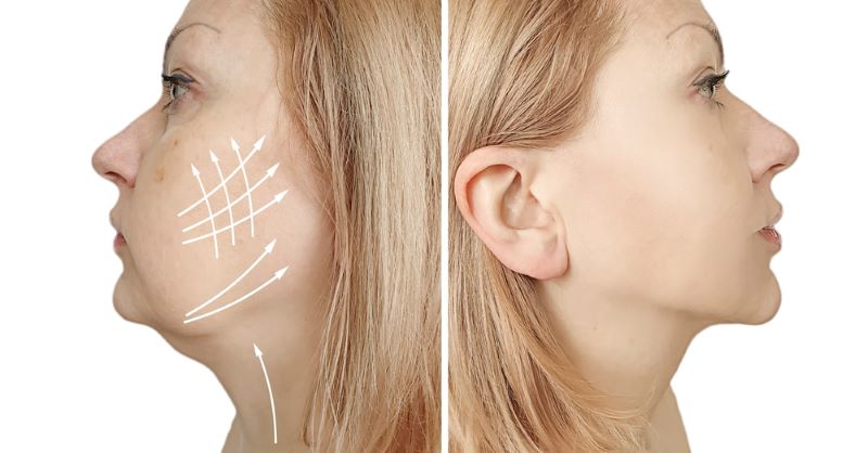 Facelift and Necklift