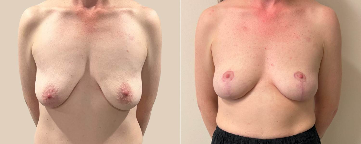 Breast Lift Before After