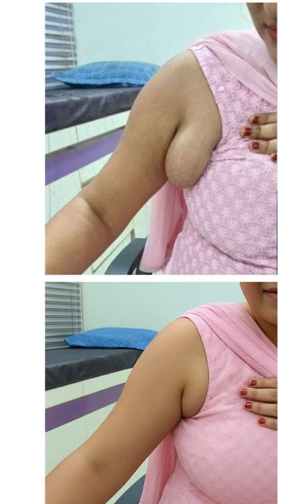 Axillary Breast Removal Before After