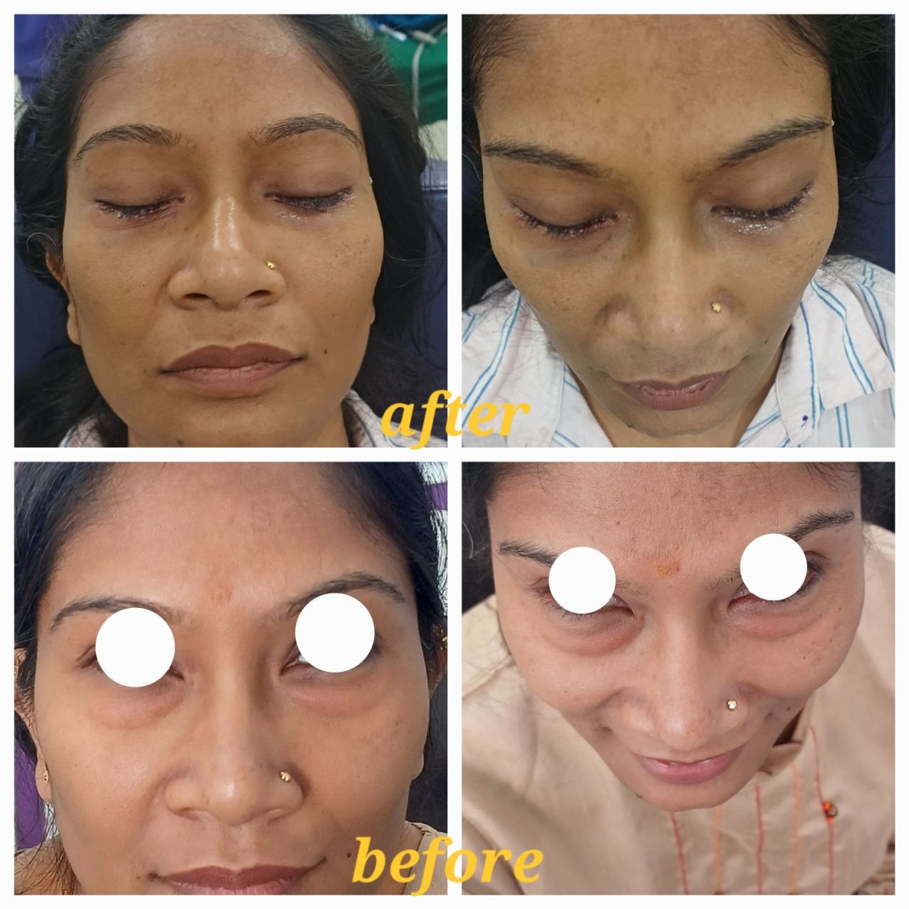Eyelid Surgery Before After