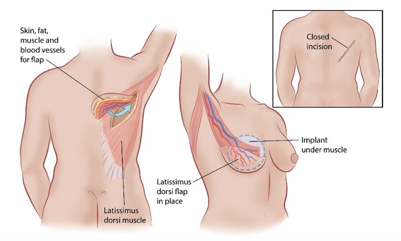 Autologous Flap Breast Reconstruction