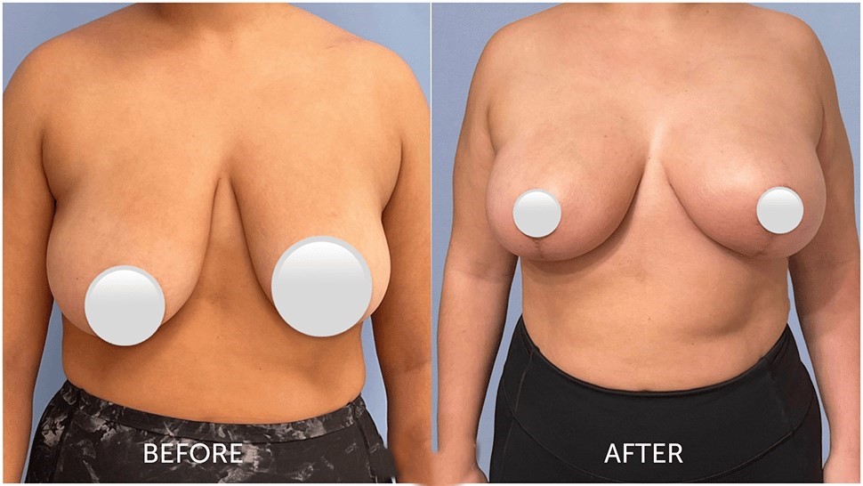 Breast Reshaping Before After