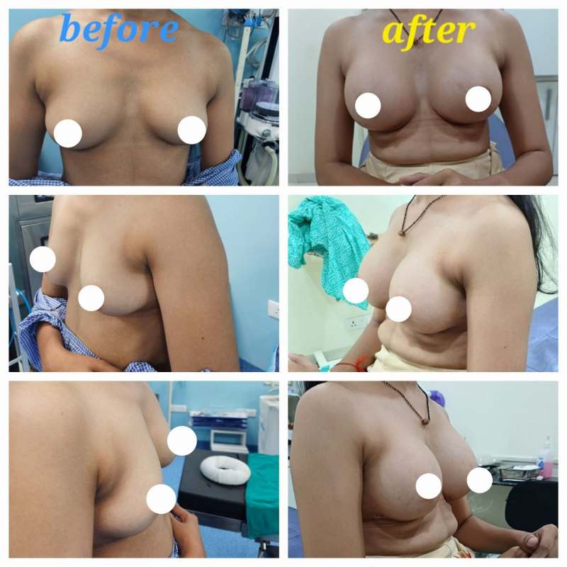 Breast Lift Before After