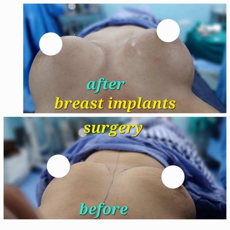 Breast Augmentation Before After