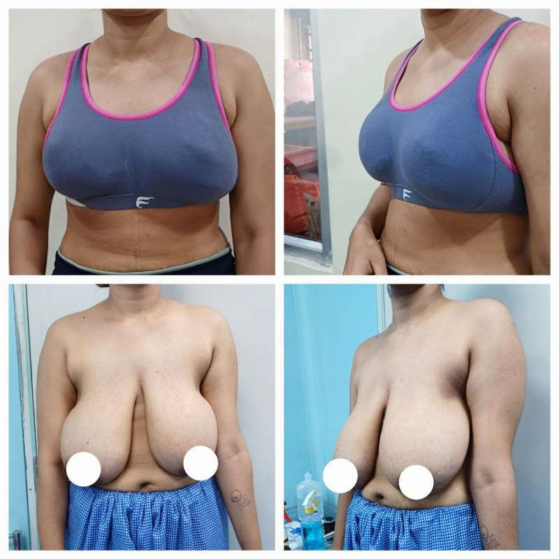 Breast Reduction Before After