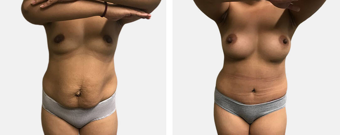 Mommy Makeover Before After