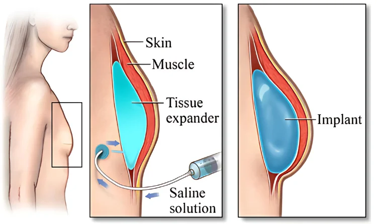 Implant Breast Reconstruction