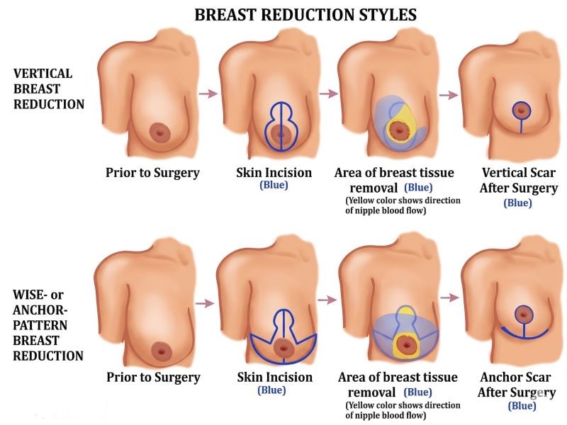 Breast Reduction Technique
