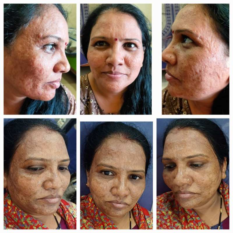 CO2 Laser Resurfacing Before After