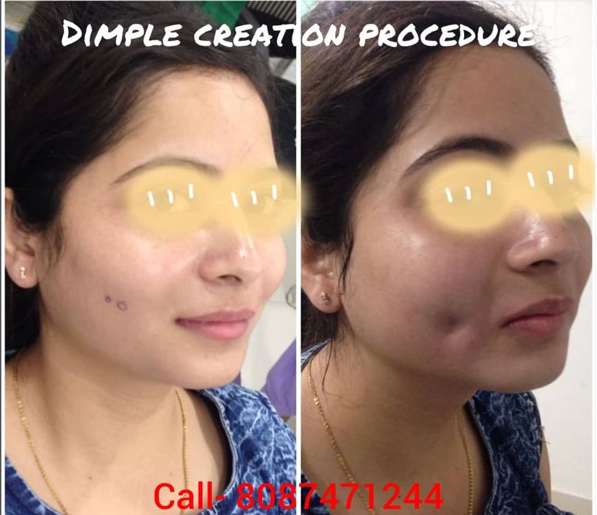 Dimpleplasty Before After