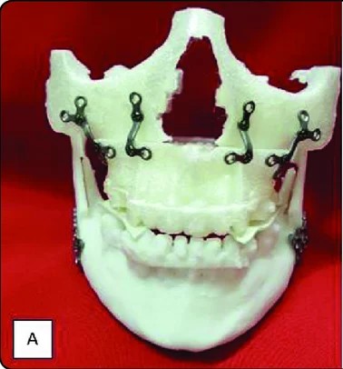 Maxillofacial Surgery Techniques