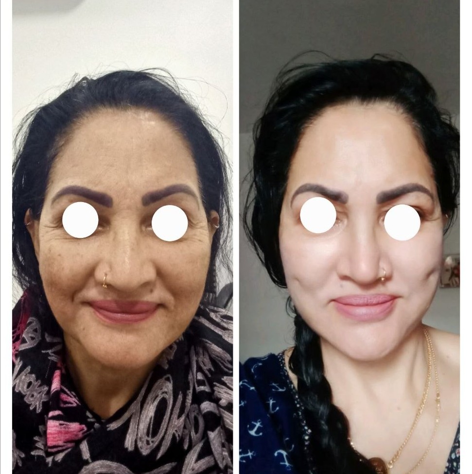 Facelift Before After