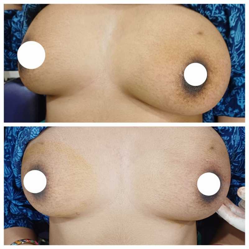 Fibroadenoma Removal Before After