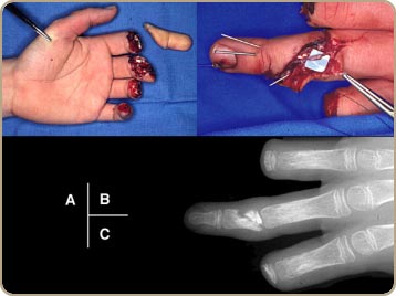 Finger Replantation