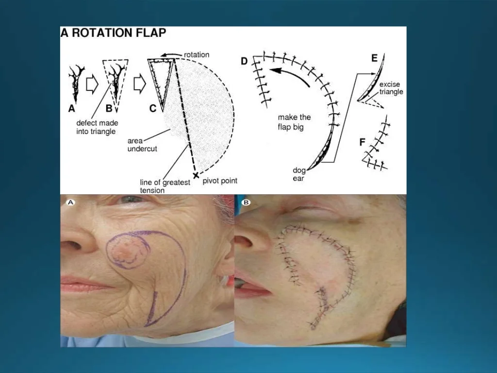 Post Cancer Reconstruction