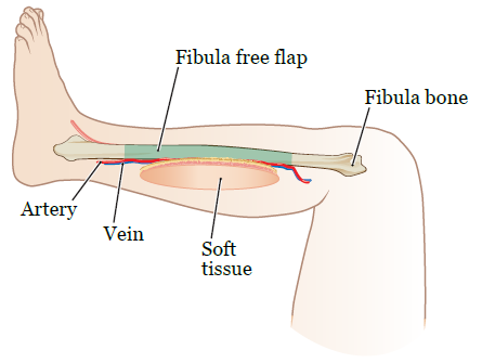 Free Flap Tissue Transfer