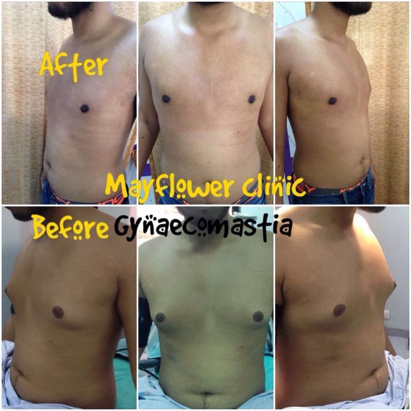 Gynecomastia Grade 2