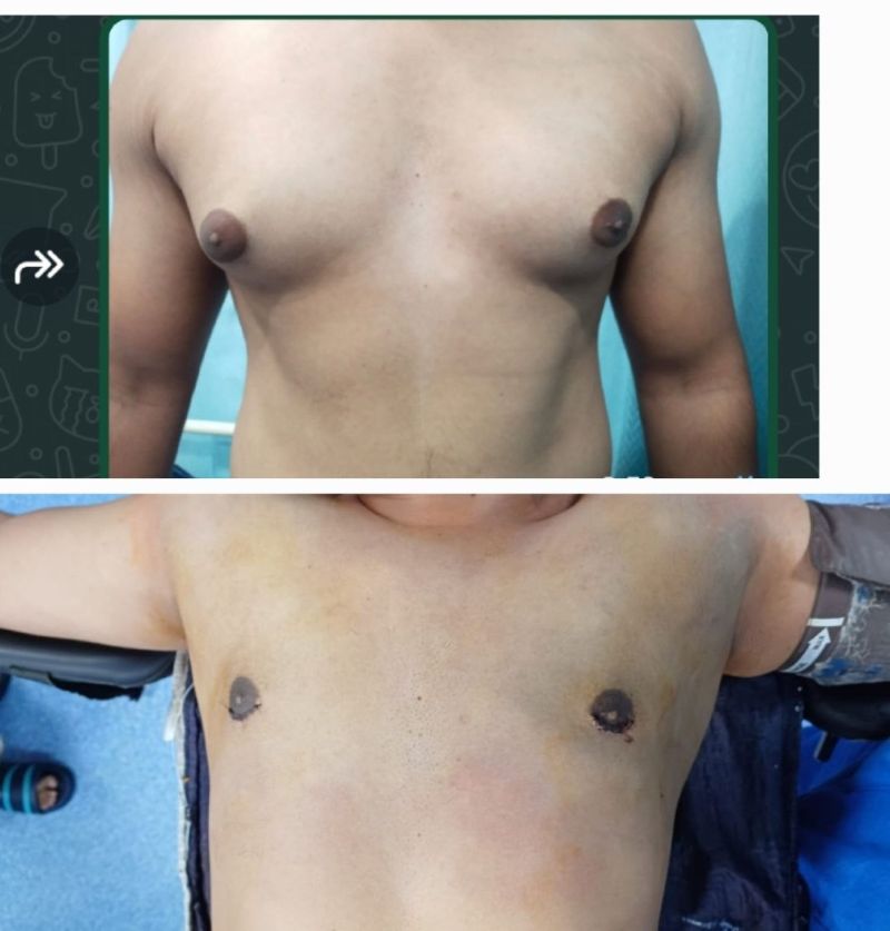 Gynecomastia Grade 3