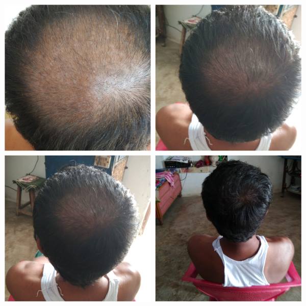 Beard Transplant Before After