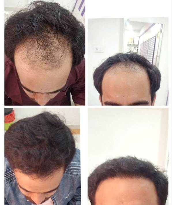 FUE Hair Transplant Before After
