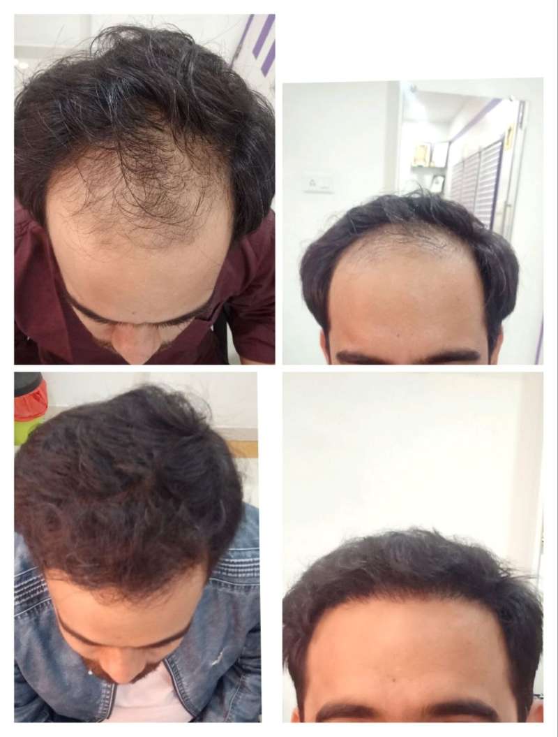 FUE Hair Transplant Before After