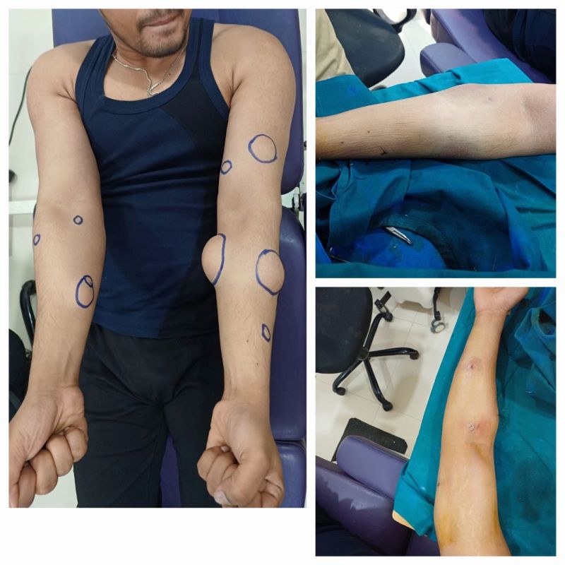 Lipoma Removal Before After