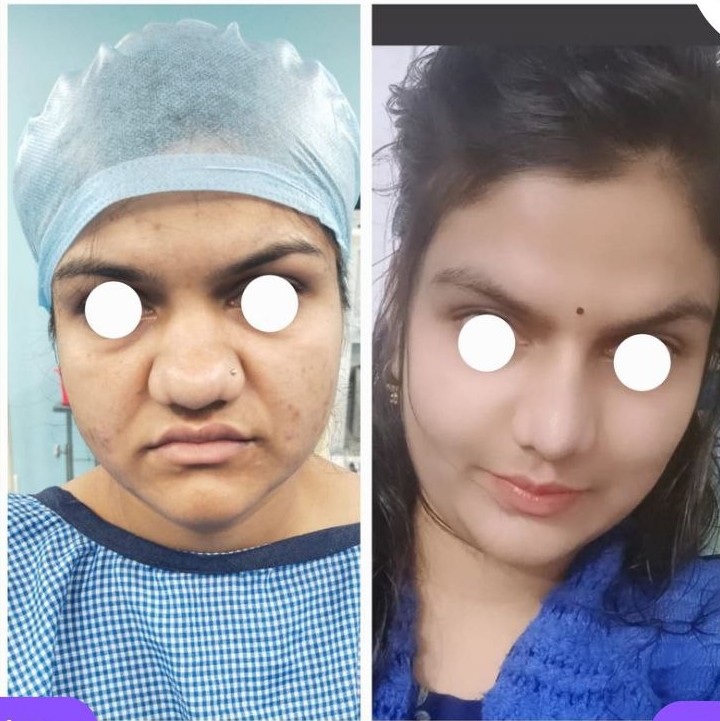 Rhinoplasty Bulbous Tip