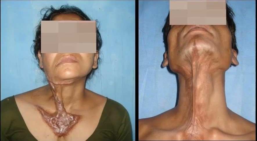 Flap Surgery for Contractures