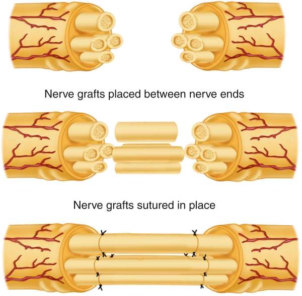 Nerve Grafting
