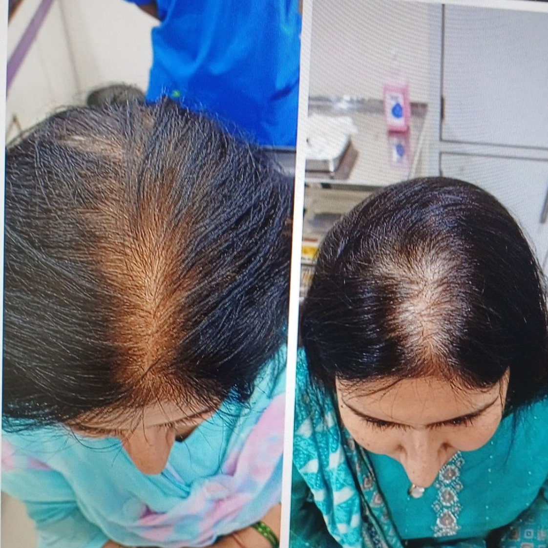 Regenerative Hair Therapy