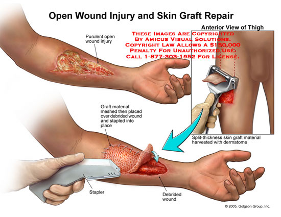 Early Excision and Grafting