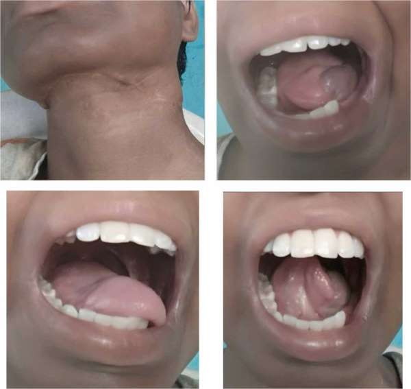 Tongue and Oral Reconstruction