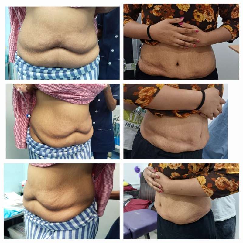 Tummy Tuck Before After