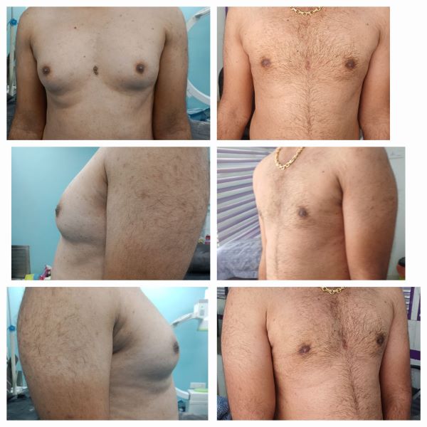 Gynecomastia Grade 2 Before After