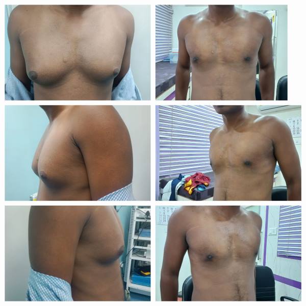 Gynecomastia Grade 3 Before After