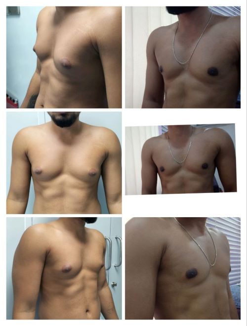 Gynecomastia Grade 1