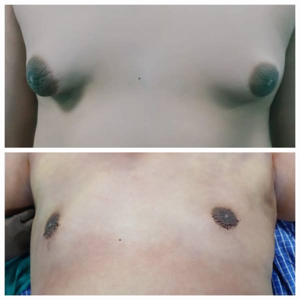 Gynecomastia Grade 4