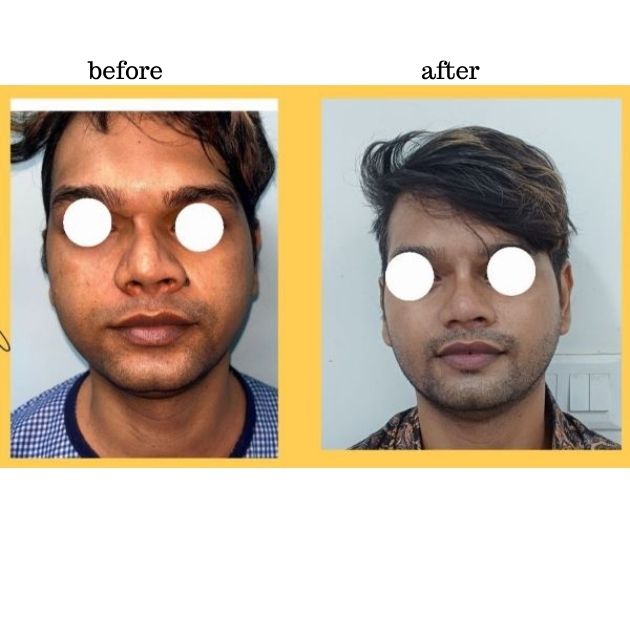 Male Rhinoplasty