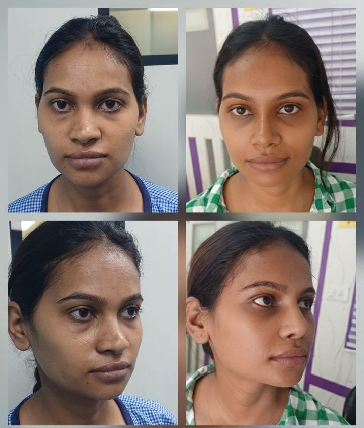 Max lift rhinoplasty Nagpur profile optimization result