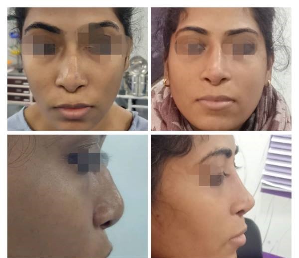 Revision Rhinoplasty