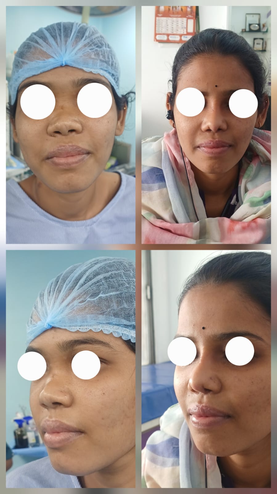 Rhinoplasty in Nagpur before after case 1 dorsum augmentation