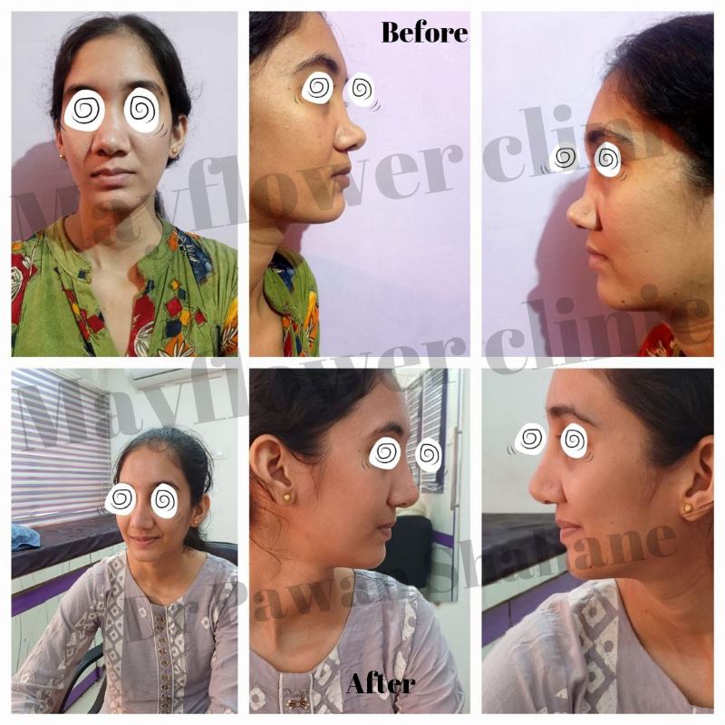 Dorsal augmentation rhinoplasty Nagpur case result