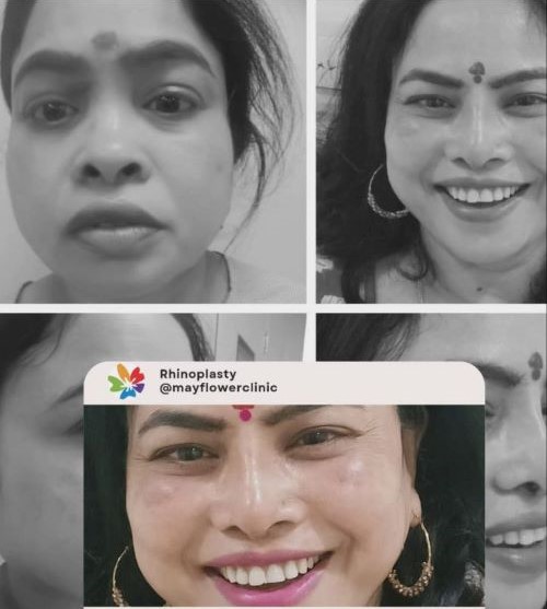 Rhinoplasty depressed nose