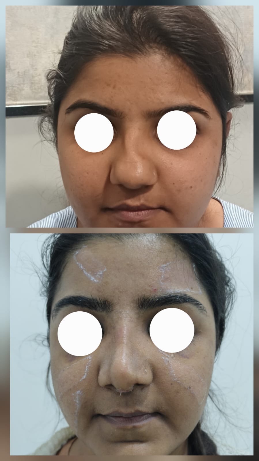 Septorhinoplasty Nagpur functional breathing correction result